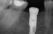Имплантация зубов качественно в Марьино у специалиста